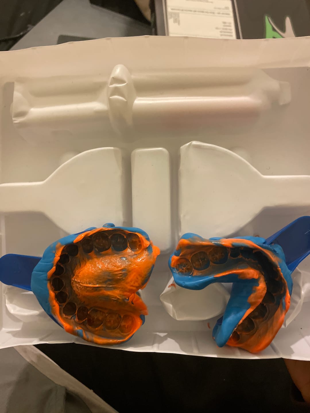 Customer photo review of Upper & Lower Impression Kit