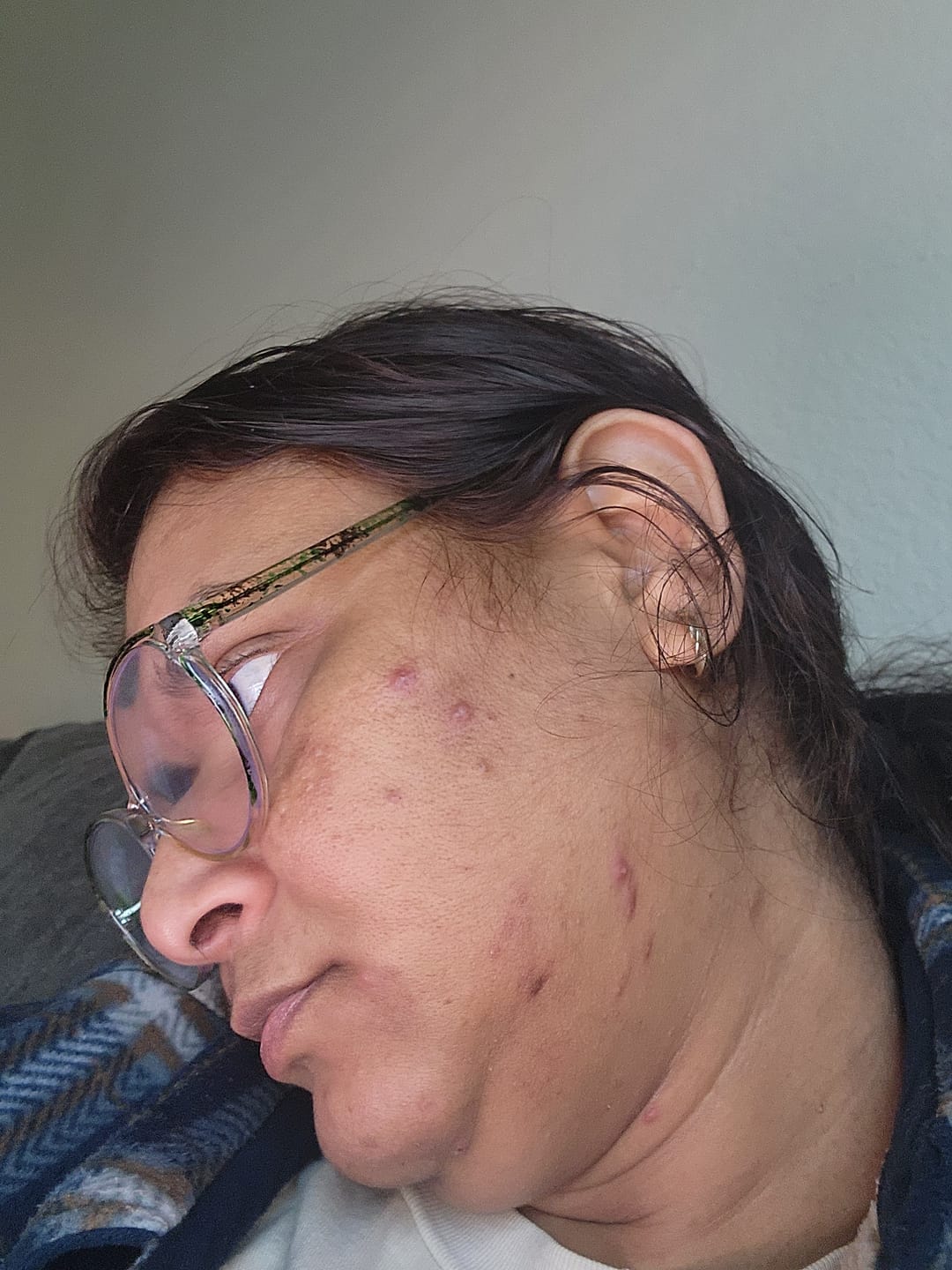 Customer photo review of The Complete Acne System for Women
