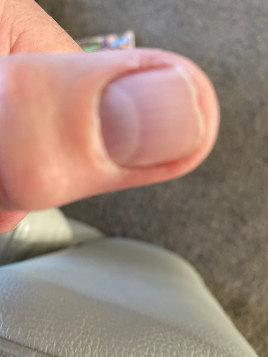 Customer photo review of Podopharm Therapy Onygen Cream with Colostrum for Damaged and Weakened Nails 20ml