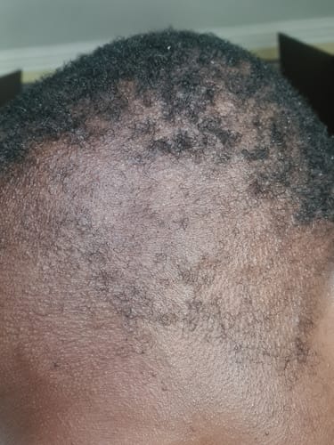 Customer photo review of Scalp Serum Set - Minoxidil