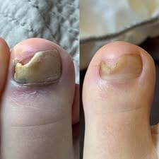 Customer photo review of HZA™ 5X Quick-healing Nail Fungus Ointment