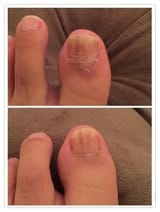 Customer photo review of HZA™ 5X Quick-healing Nail Fungus Ointment