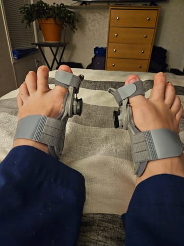 Customer photo review of Treatmedy™ Bunion Fix - Natural At-Home Bunion Relief