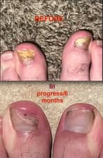 Customer photo review of HZA™ 5X Quick-healing Nail Fungus Ointment