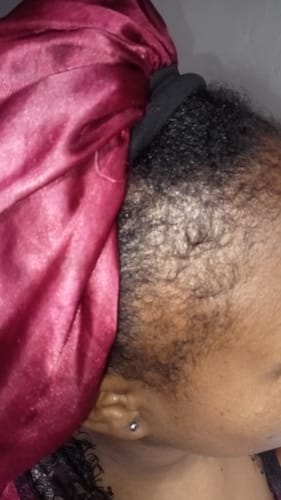 Customer photo review of Minoxi5 Minoxidil SOLUTION, 1 PACK