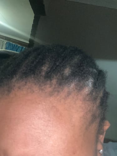 Customer photo review of Minoxi5 Minoxidil SOLUTION, 3 PACK