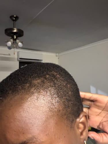 Customer photo review of Minoxi5 Minoxidil FOAM , 3 PACK