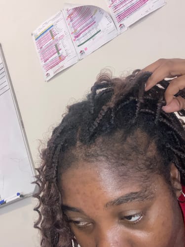 Customer photo review of NOVIFUL Hair Growth Serum - 3 PACK (3 Month supply)