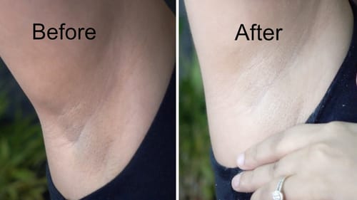Customer photo review of Kojic® Whitening Cream