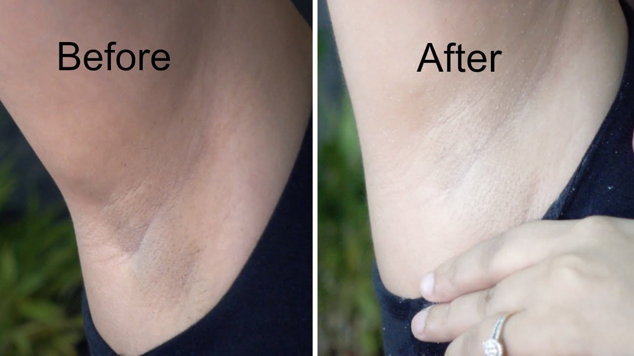 Customer photo review of Kojic® Whitening Cream