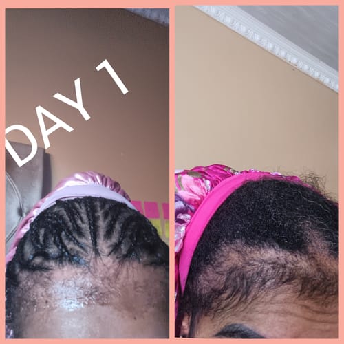 Customer photo review of Minoxi5 Minoxidil SOLUTION, 3 PACK