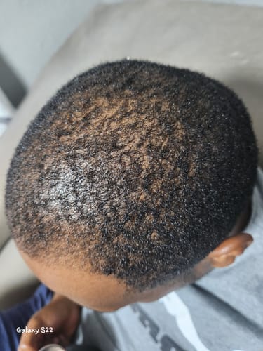 Customer photo review of Minoxi5 Minoxidil SOLUTION, 1 PACK