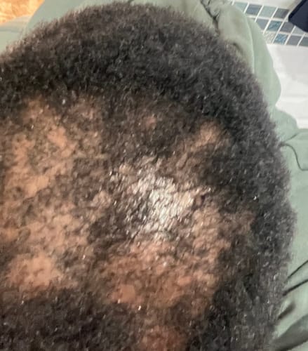 Customer photo review of Minoxi5 Minoxidil SOLUTION, 3 PACK