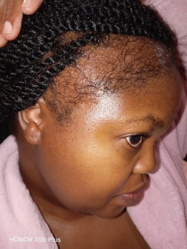 Customer photo review of Minoxi5 Minoxidil SOLUTION, 3 PACK