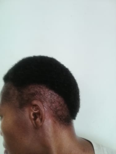 Customer photo review of Minoxi5 Minoxidil SOLUTION, 6 PACK