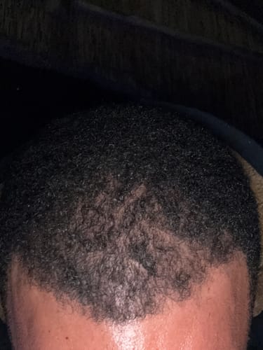 Customer photo review of Minoxi5 Minoxidil SOLUTION, 3 PACK