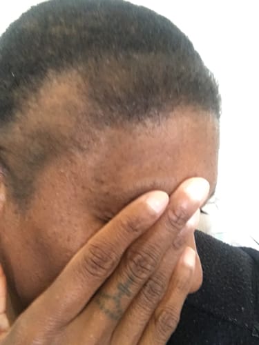 Customer photo review of NOVIFUL Hair Growth Serum - 3 PACK (3 Month supply)