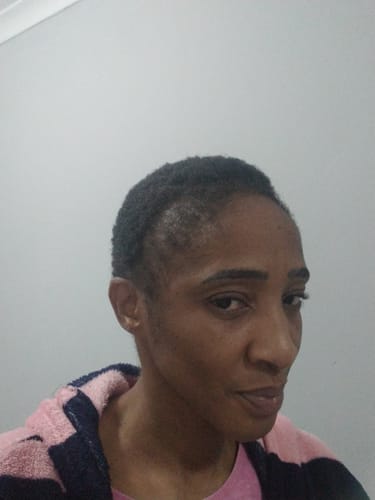 Customer photo review of Minoxi5 Minoxidil SOLUTION, 3 PACK