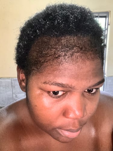 Customer photo review of Minoxi5 Minoxidil SOLUTION, 3 PACK