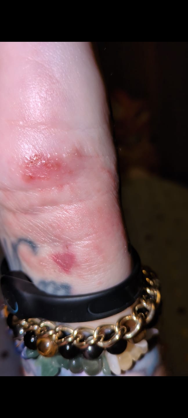Customer photo review of Bioskin Junior Outbreak Rescue Cream