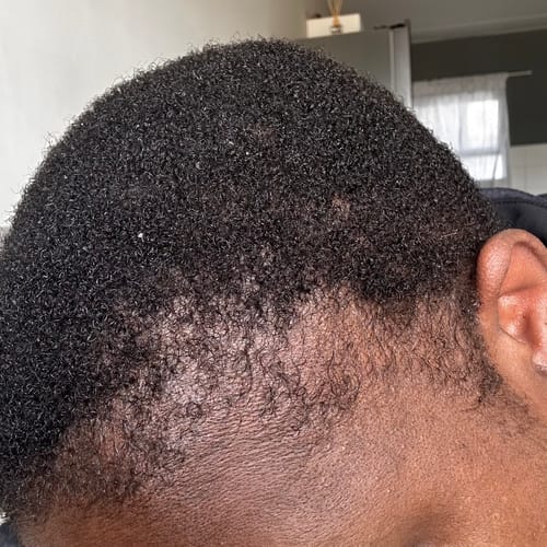 Customer photo review of Minoxi5 Minoxidil SOLUTION, 3 PACK