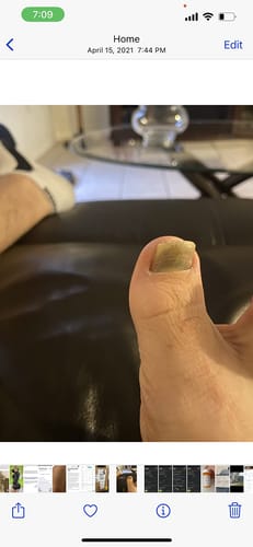 Customer photo review of LumaNail - Nail Fungus Laser Removal