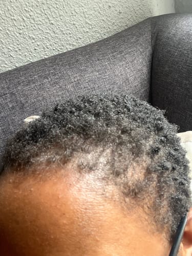 Customer photo review of Minoxi5 Minoxidil SOLUTION, 3 PACK