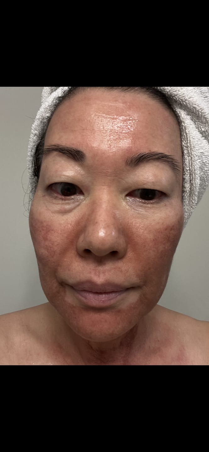Customer photo review of HEDO Signature Peel with Care Kit