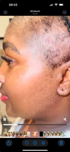 Customer photo review of Minoxi5 Minoxidil SOLUTION, 3 PACK