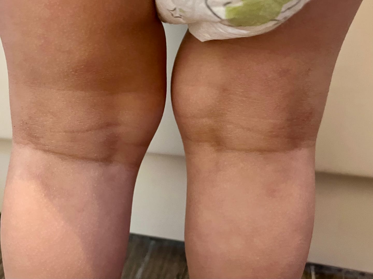 Customer photo review of Bioskin Junior Outbreak Rescue Cream