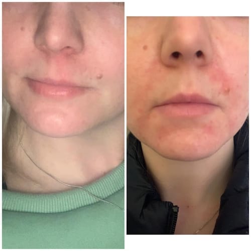 Customer photo review of The Complete Acne Killer System 2.0