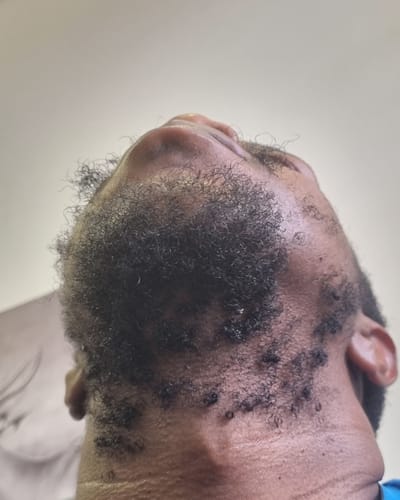 Customer photo review of Minoxi5 Minoxidil FOAM , 3 PACK