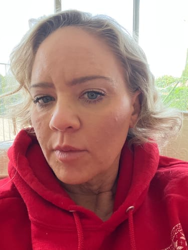 Customer photo review of The Complete Acne Killer System 2.0