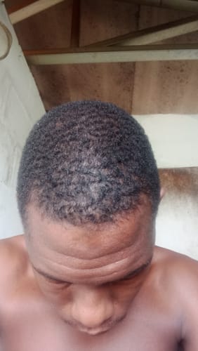 Customer photo review of Minoxi5 Minoxidil SOLUTION, 3 PACK