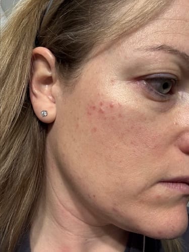 Customer photo review of The Complete Acne Killer System 2.0