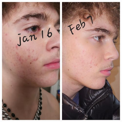 Customer photo review of The Complete Acne Killer System 2.0