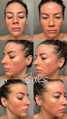 Customer photo review of The Complete Acne Killer System 2.0