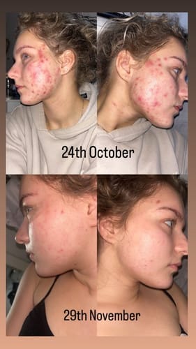 Customer photo review of The Complete Acne Killer System 2.0