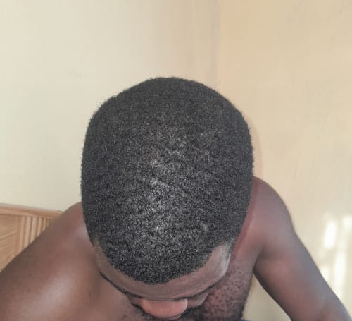 Customer photo review of Minoxi5 Minoxidil SOLUTION, 3 PACK