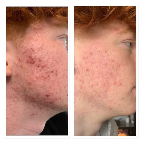 Customer photo review of The Complete Acne Killer System 2.0