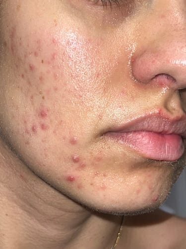 Customer photo review of The Complete Acne Killer System 2.0