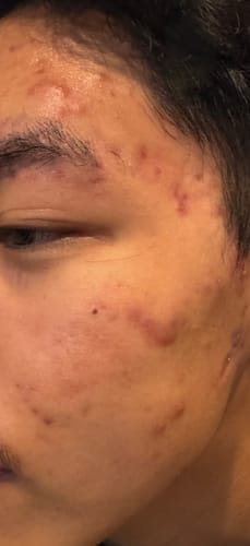 Customer photo review of The Complete Acne Killer System 2.0