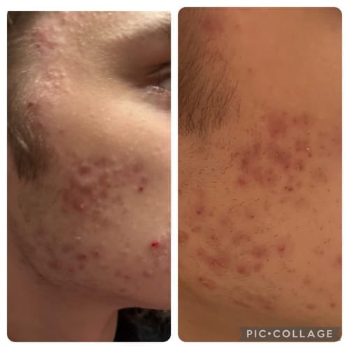 Customer photo review of The Complete Acne Killer System 2.0