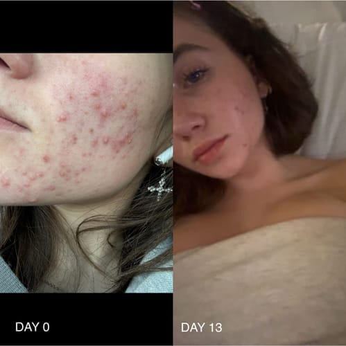 Customer photo review of The Complete Acne Killer System 2.0