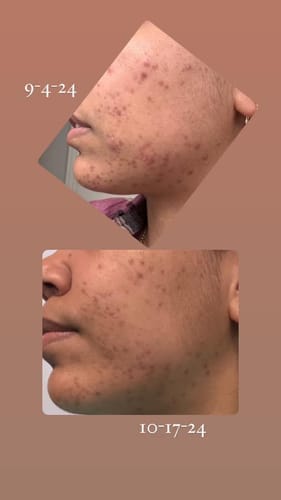 Customer photo review of The Complete Acne Killer System 2.0