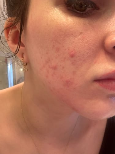 Customer photo review of The Complete Acne Killer System 2.0
