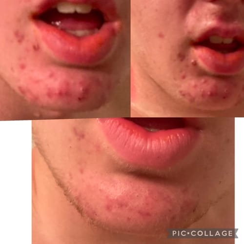 Customer photo review of The Complete Acne Killer System 2.0