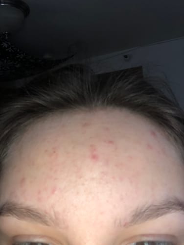 Customer photo review of The Complete Acne Killer System 2.0