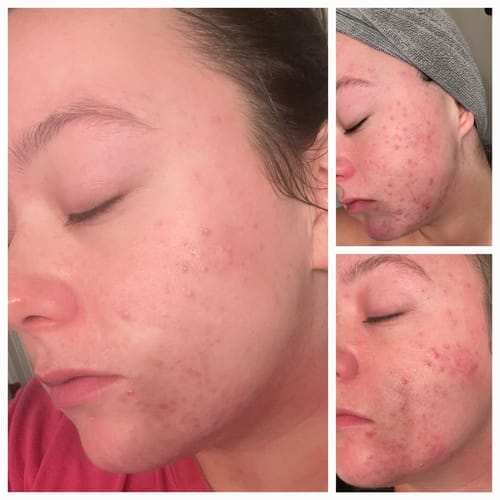 Customer photo review of The Complete Acne Killer System 2.0