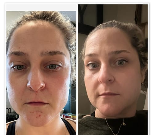 Customer photo review of The Complete Acne Killer System 2.0